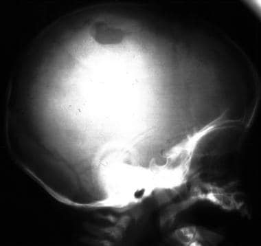 Lateral skull radiograph in a child with a growing