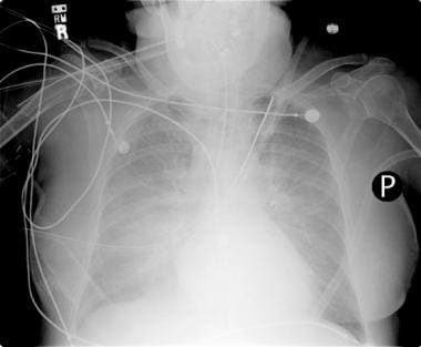 Portable chest radiograph. This image shows bilate