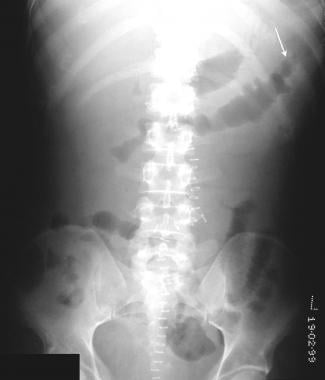 Postoperative abdominal radiograph in a 26-year-ol