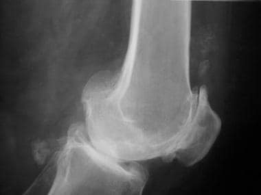 Lateral radiograph of the knee reveals patellofemo