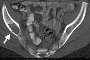 Computed tomography (CT) scan demonstrates the cha