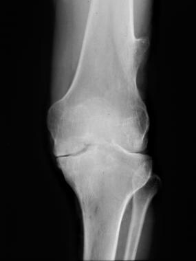 Knee radiograph in a 37-year-old man with moderate