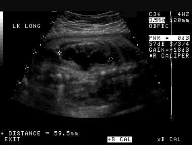 Prenatal longitudinal sonogram of the left kidney.