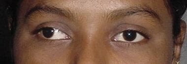 Patient with intermittent exotropia at both distan