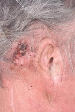Close-up view of an elderly man with a recurrent s