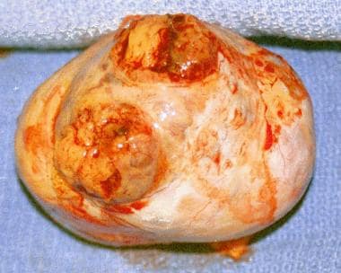 Granulosa cell tumor excised from a woman aged 44 