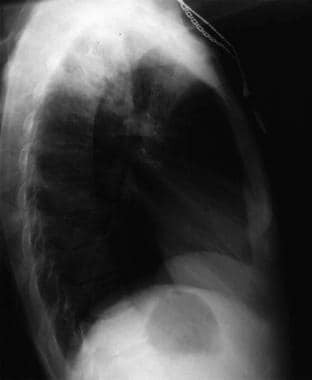 Laterale radiografie van de borstkas bij een 31-jarige patiënt