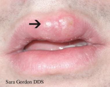 Mild Herpes Photographs - herpes-coldsores.com