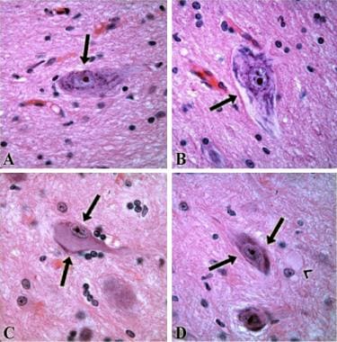 Dysmorphic neurons (arrows), with cytoplasm showin