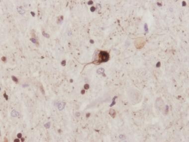 Pathology of motor neuron disorders. Amyotrophic l