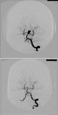 Endovascular coiling of large basilar tip aneurysm