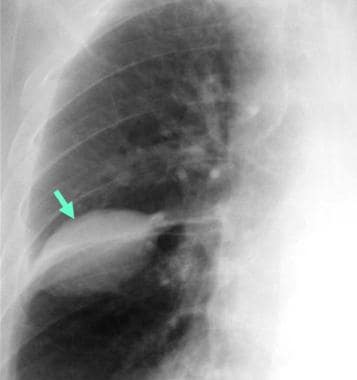 Loculated effusion in the minor fissure (arrow). T