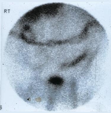 Scan obtained with technetium-99m hexamethylpropyl