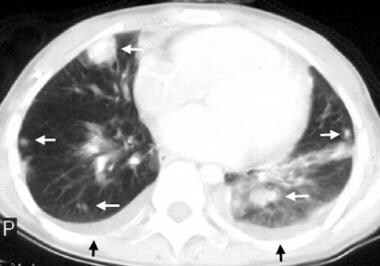 Computed tomography (CT) scan of the lungs shows m