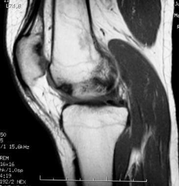 Extensor mechanism injuries of the knee. This 42-y