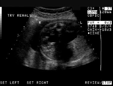 Prenatal axial sonogram of the abdomen. This image