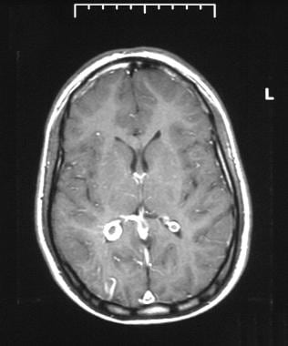 Axial T1-weighted gadolinium-enhanced MRI through 