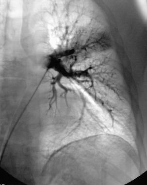 Pulmonary angiography. Left pulmonary angiogram wa