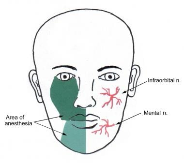 Areas of regional nerve blocks for the lips. 