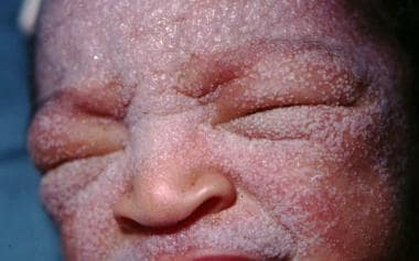Miliaria crystallina in an infant. Note that the l