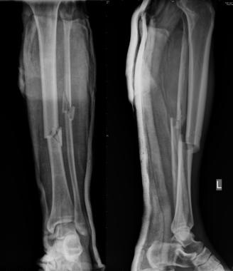 Diaphyseal tibial fracture. Preoperative anteropos