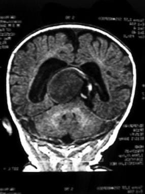 Coronal MRI of head showing large central vein of 