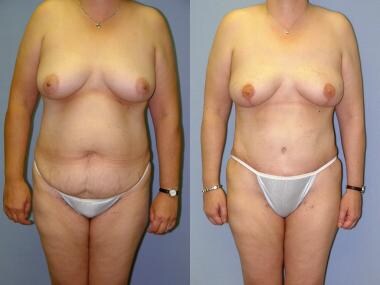 Before and after bilateral prophylactic skin-spari