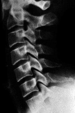 Radiograph of the lateral cervical spine shows a n