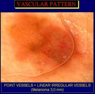 Linear irregular vessels and pinpoint dots in a ma