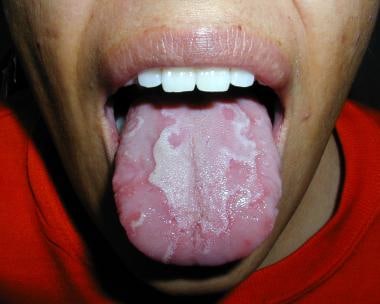 When should you see a doctor for the burning tongue disease?