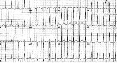 Electrocardiogram from a 46-year-old man with long
