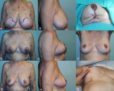 Simplified vertical breast reduction in a 34-year-