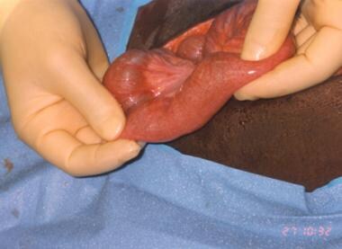 Appearance of bowel after removal of intraperitone