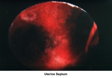 Infertility. Uterine septum. Image courtesy of Jai