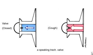Diagram of a speaking tracheostomy valve. 
