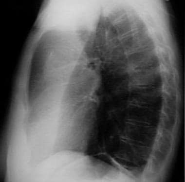 Lateral chest radiograph demonstrating a left uppe