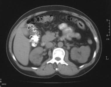 Nonenhanced computed tomography scan of the kidney
