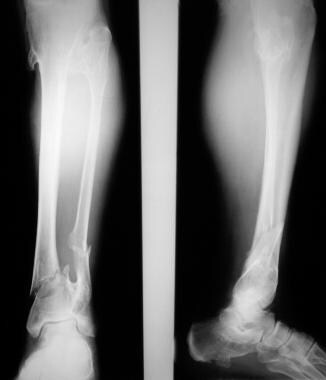 Multiple osteochondromatosis. Fractures of the low