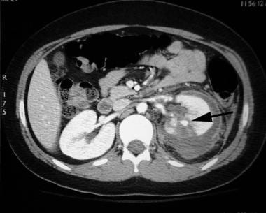 Contrast-enhanced CT in a 9-year-old boy who susta