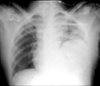 Pediatric Thoracic Trauma. Posteroanterior chest r