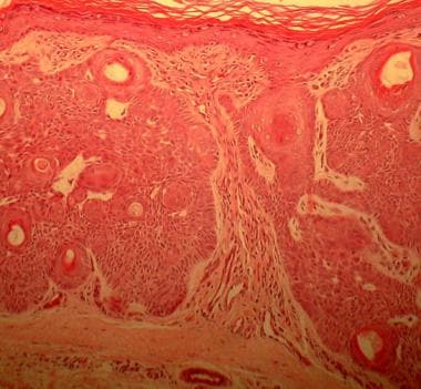 Tumor of the follicular infundibulum shows epiderm
