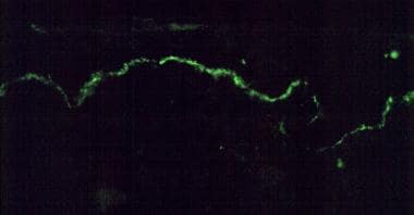 By direct immunofluorescence, a linear band of imm