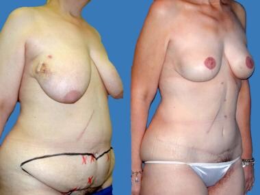 Before and after bilateral mastectomy for ductal c