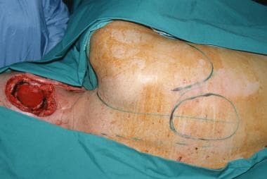 Skin markings showing the planned trapezius island