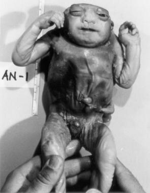 Ventral view of a child with anencephaly that, lik