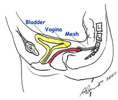 Enterocele and massive vaginal eversion. Note the