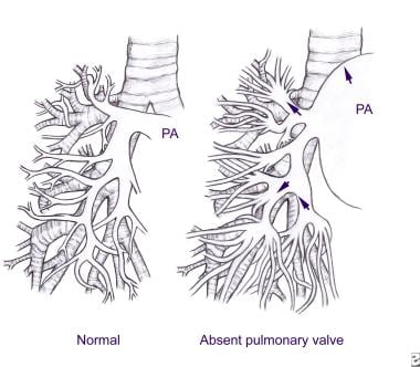 Tetralogy of Fallot With Absent Pulmonary Valve. P