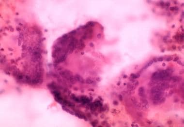 Three multinuclear, giant cell granulomas observed