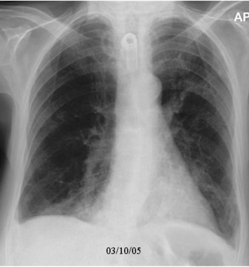 A case of evolving aspiration pneumonia (4 of 4 im