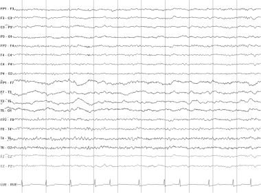 Continuous polymorphic delta. This EEG is from a 2
